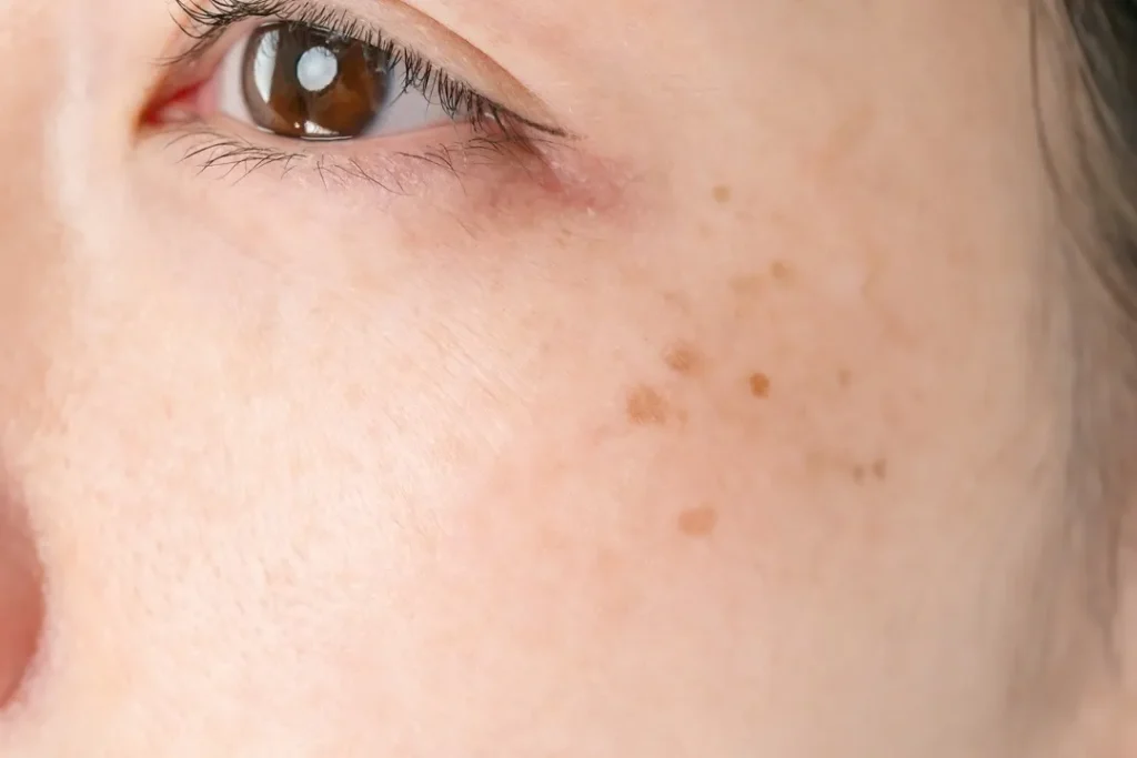 ملاسما یک نوع از لک‌های پوستی است که اغلب به صورت لکه‌های قهوه‌ای یا خاکستری بر روی صورت ظاهر می‌شود.