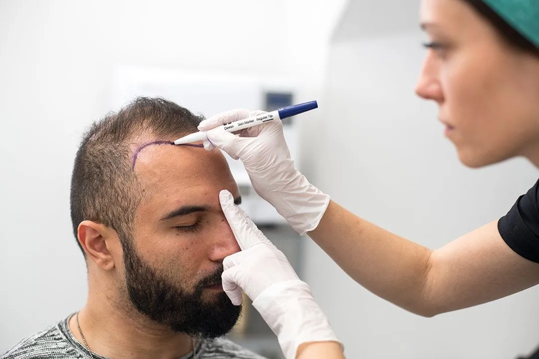 کاشت مو یکی از روش‌های موثر برای بازگرداندن موهای از دست‌رفته و افزایش اعتمادبه‌نفس است.