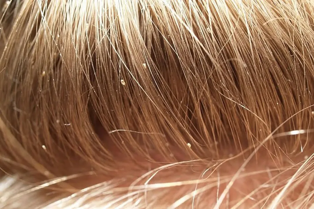 شپش سر یکی از مشکلات شایع بهداشتی است که اغلب در کودکان مدرسه‌ای و حتی در بزرگسالان دیده می‌شود.