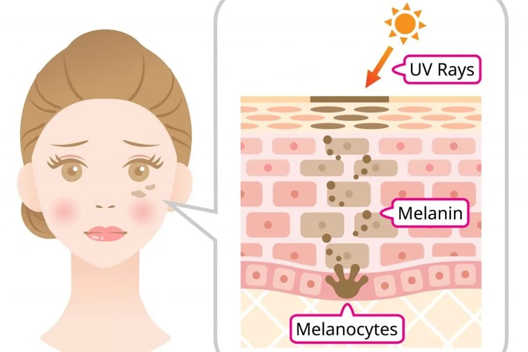 اشعه فرابنفش (UV) باعث تخریب کلاژن و ایجاد لک‌های پوستی می‌شود.