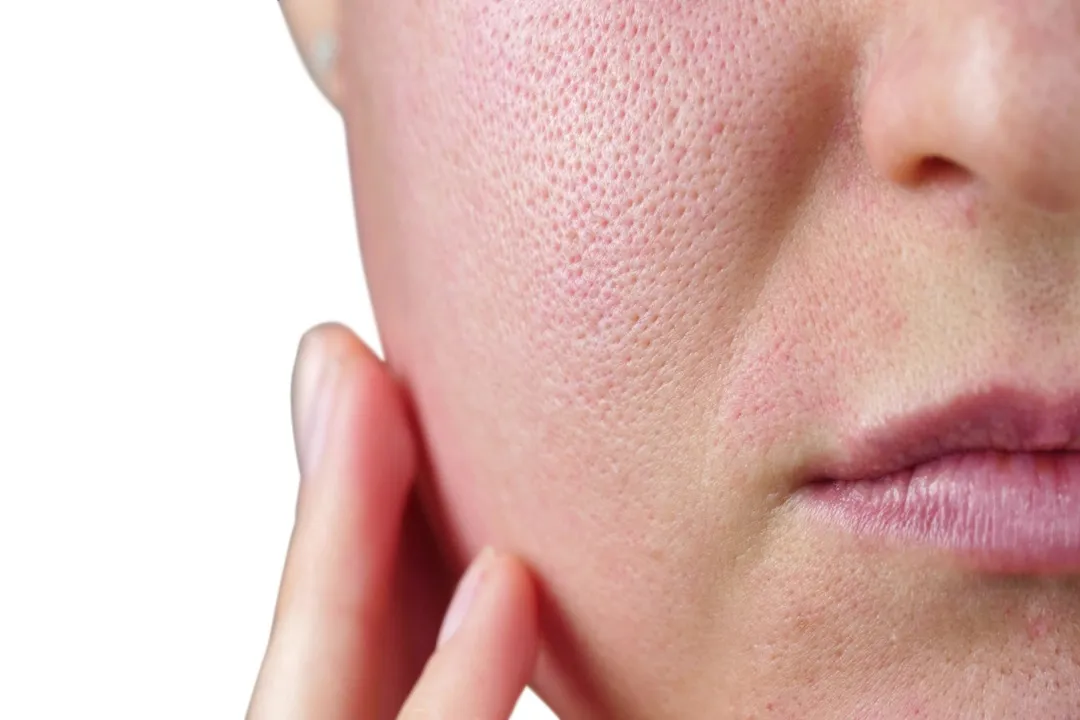 کاهش منافذ باز از فواید میکرودرم ابریژن است